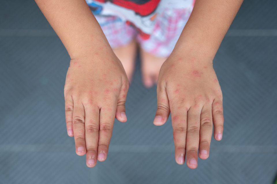 Bostonka - dłonie chorego dziecka